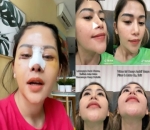 Lakukan Oplas Hidung