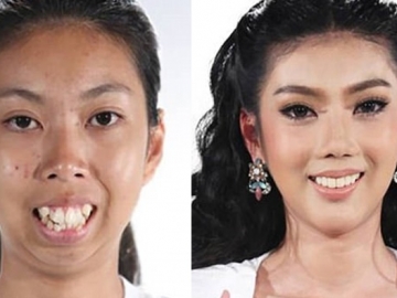 Sebelum dan Sesudah, Transformasi Menakjubkan Wanita Thailand Setelah Operasi Plastik