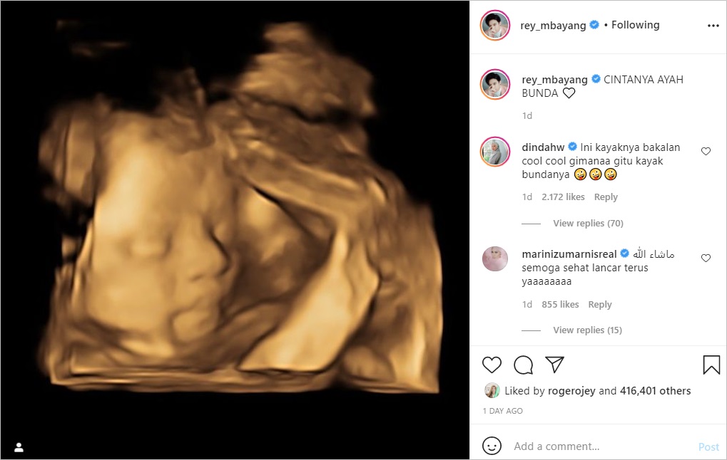 Potret USG Terbaru Bayi Dinda Hauw dan Rey Mbayang Jadi Perbincangan, Ternyata Gara-gara Ini